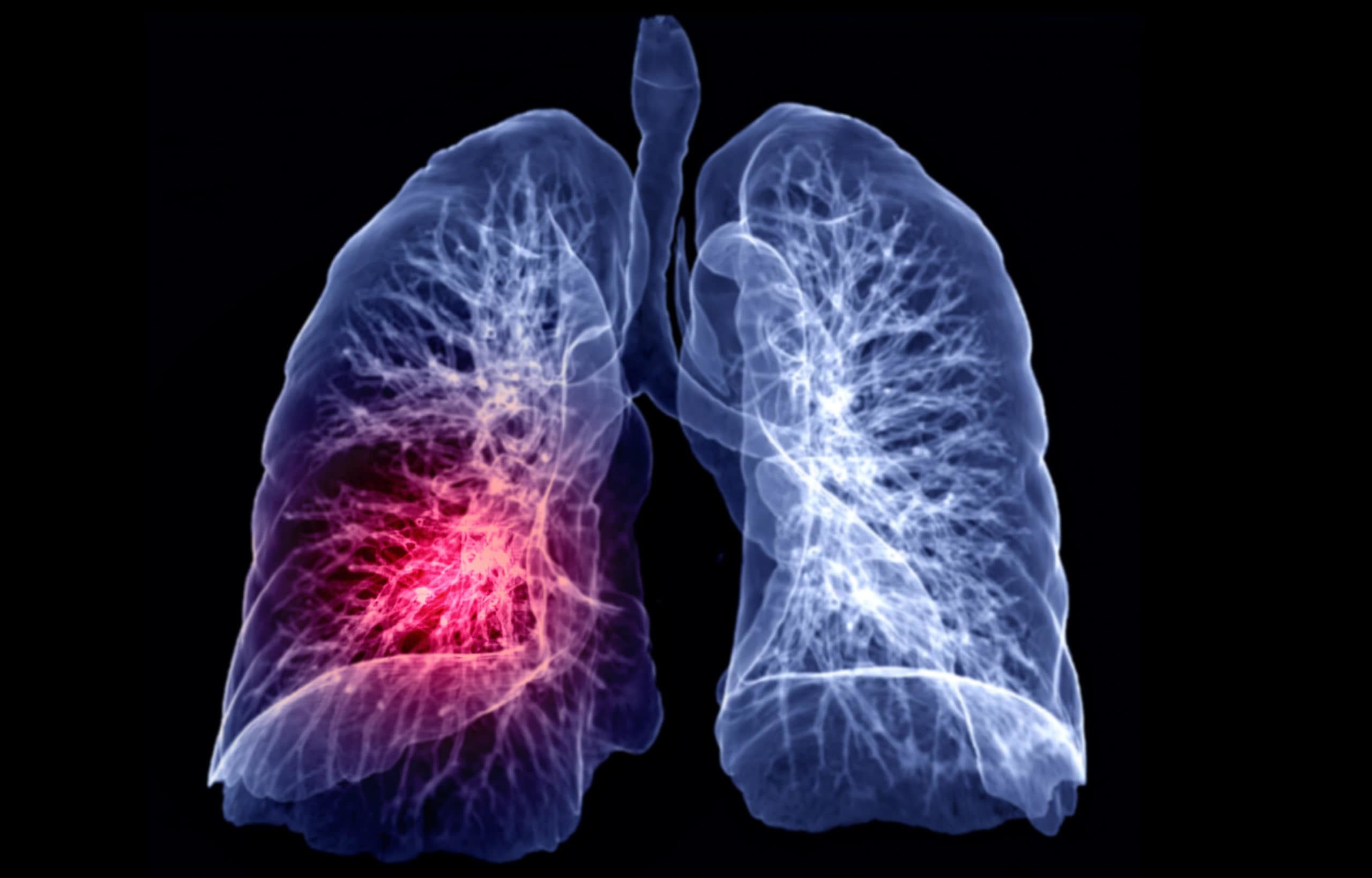 Lung scan image