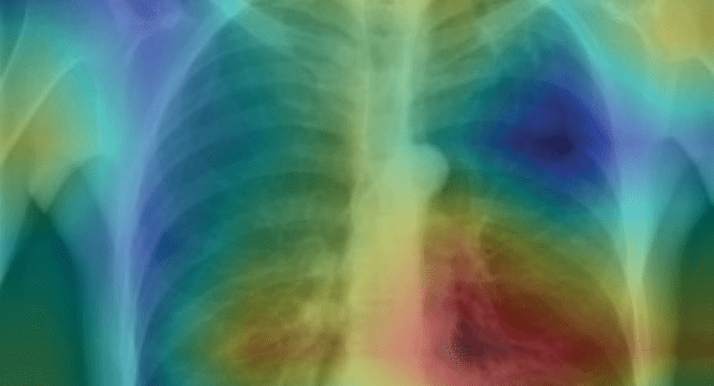 Heat Map of Pneumonia in Chest X-rays