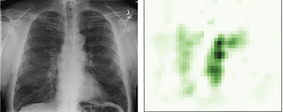 Chest X-Ray and AI Pixels