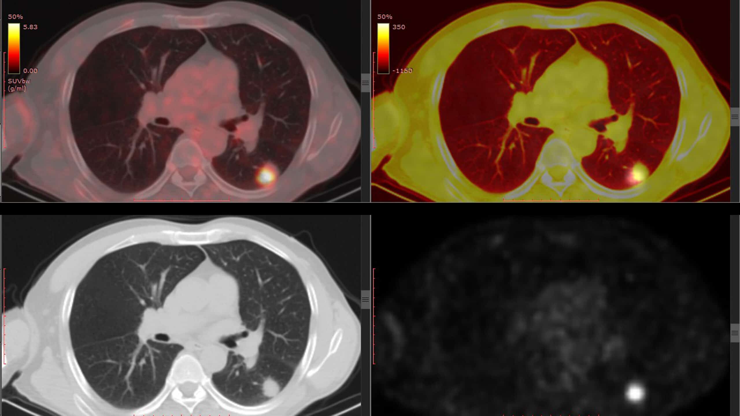 Lung Nodule CT Scans