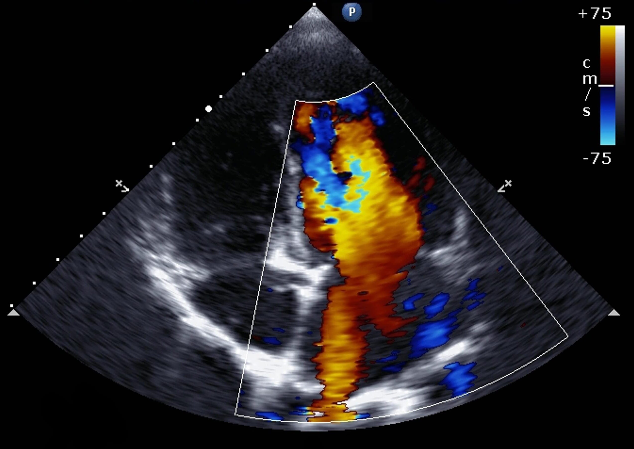 Echo AI Detects More Aortic Stenosis