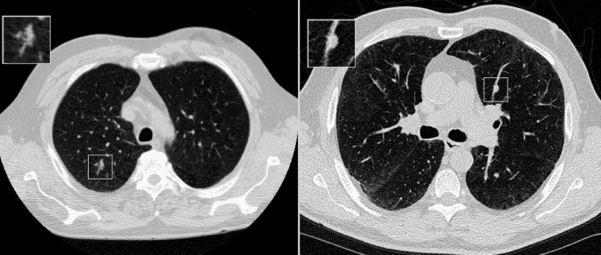 CADx’s Lung Nodule Impact