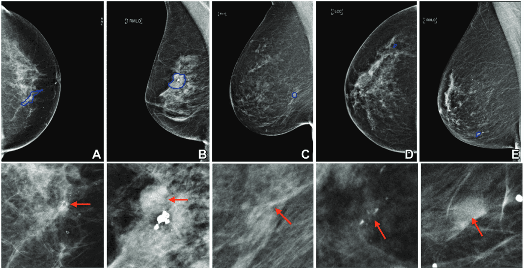Multimodal AI Virtual Breast Biopsies