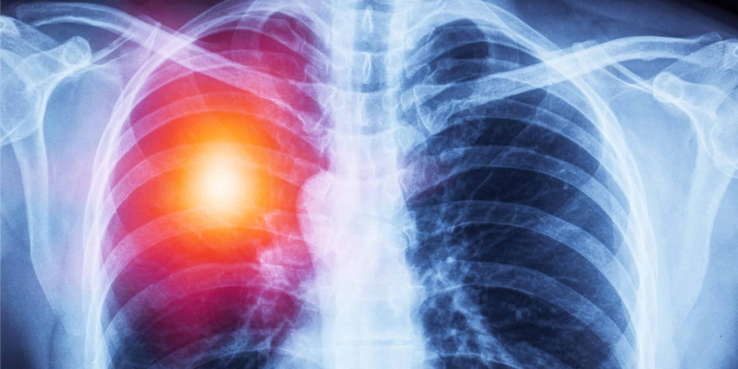 Chest X-ray AI