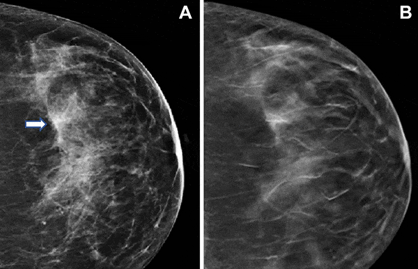 Digital breast tomosynthesis (A) vs. 2D digital mammography (B)