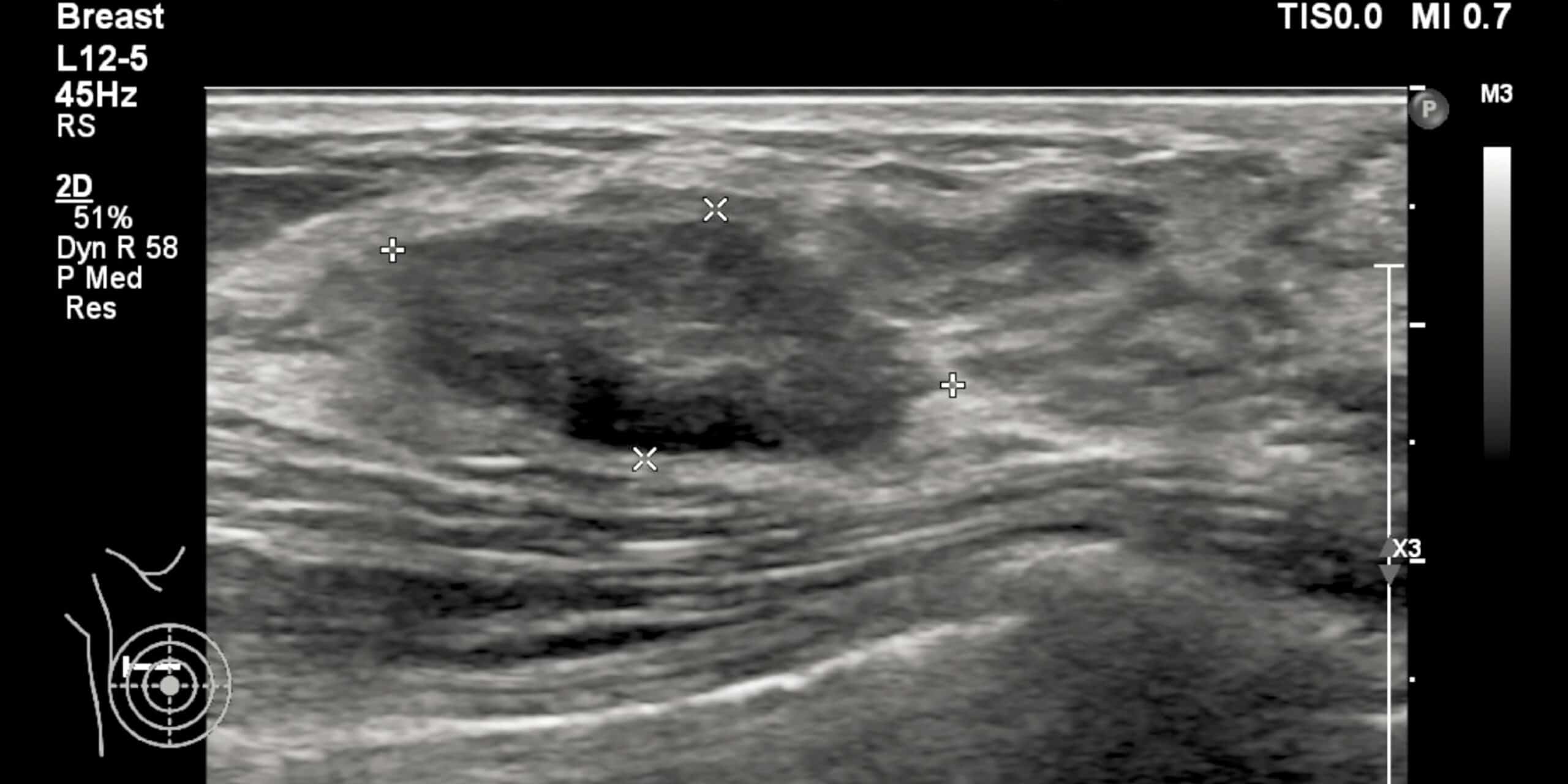 Taking Ultrasound Beyond Breast Density